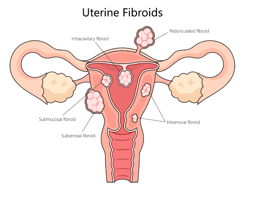 Miyom Tipleri ve Yerleşim Yerleri
